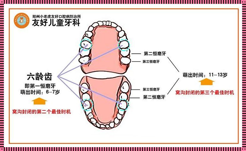 窝沟封闭：守护童年微笑的隐形盾牌