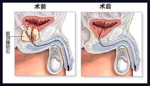 前列腺结石会引起性功能障碍吗？