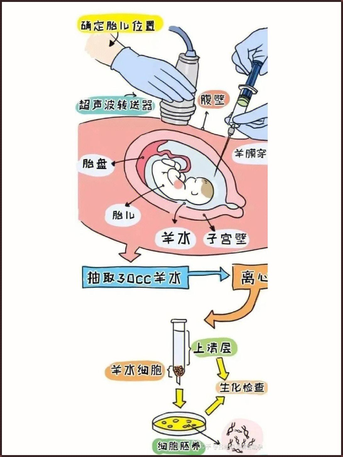 羊水穿刺：温柔的探秘之旅