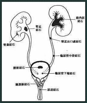 输尿管远端结石在哪里（哎呀，这小石头，躲猫猫也挑个地方吧！）