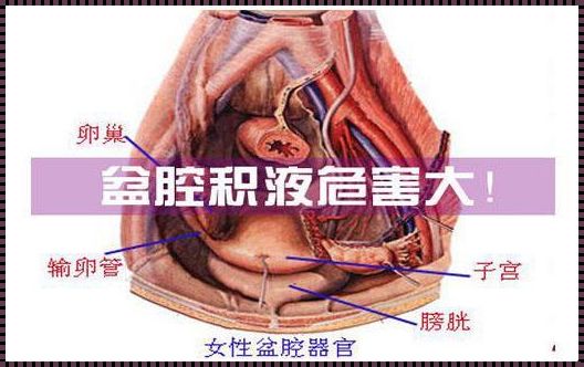 子宫直肠陷窝积液怎么造成的？揭秘“液体困局”背后的谜团