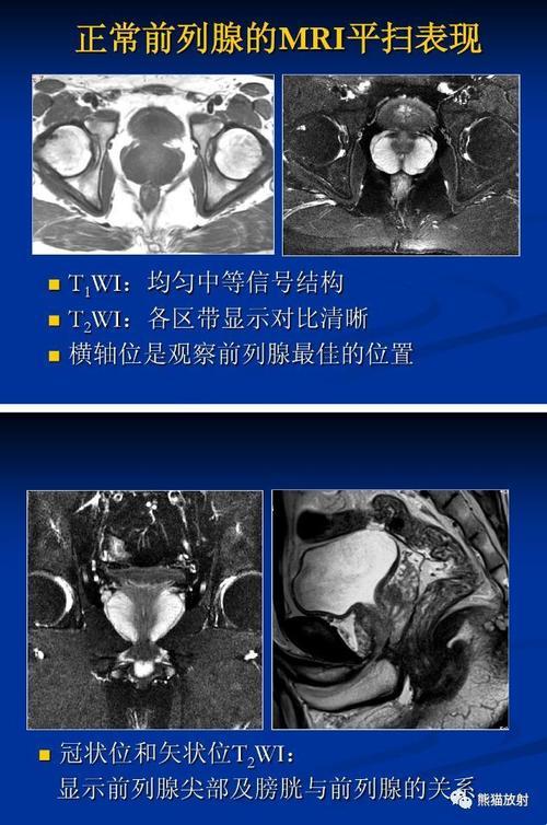 “前腺”风云：核磁共振下的笑泪人生