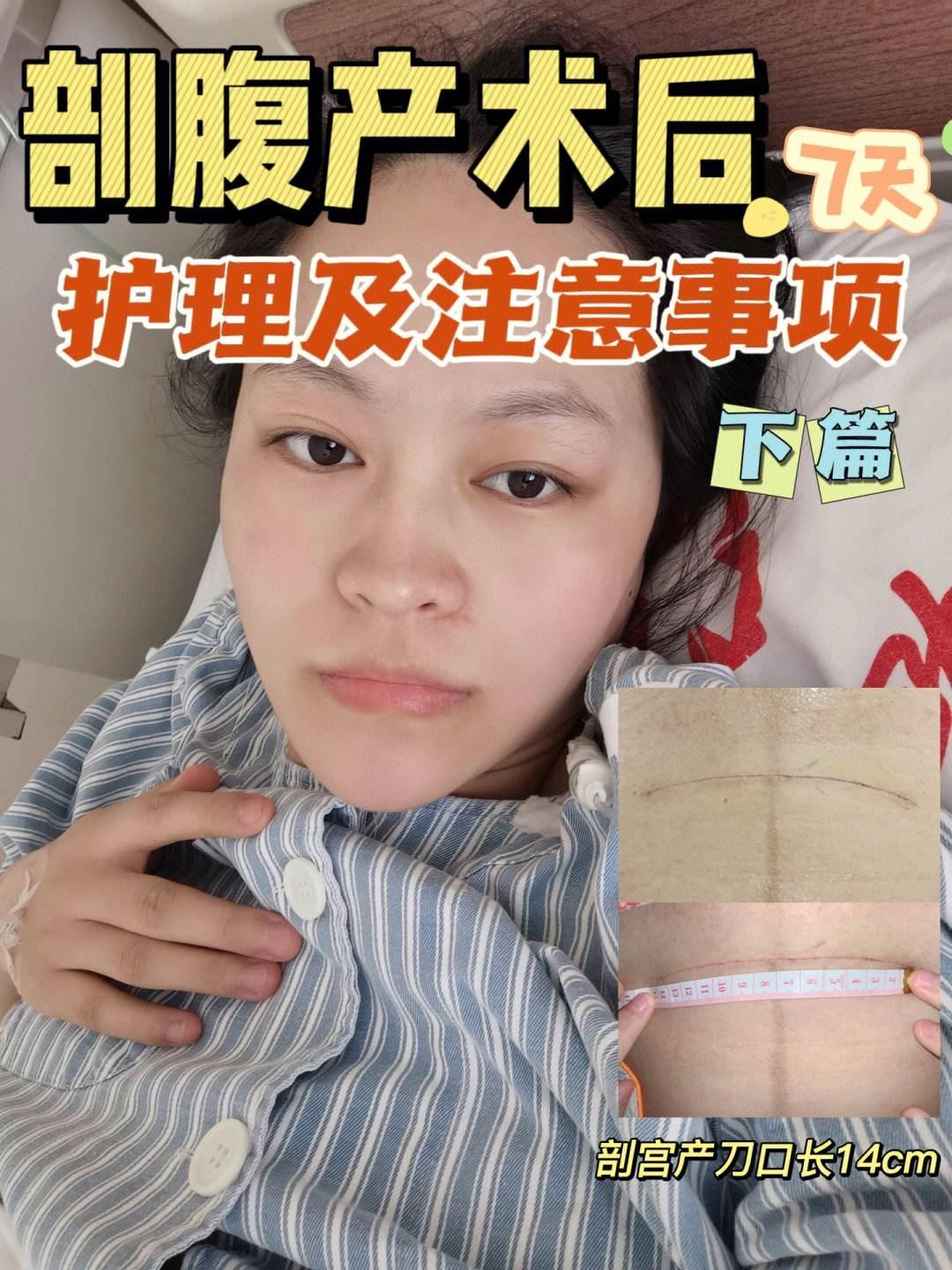 剖腹产出院后，伤口日常消毒的麻辣问答