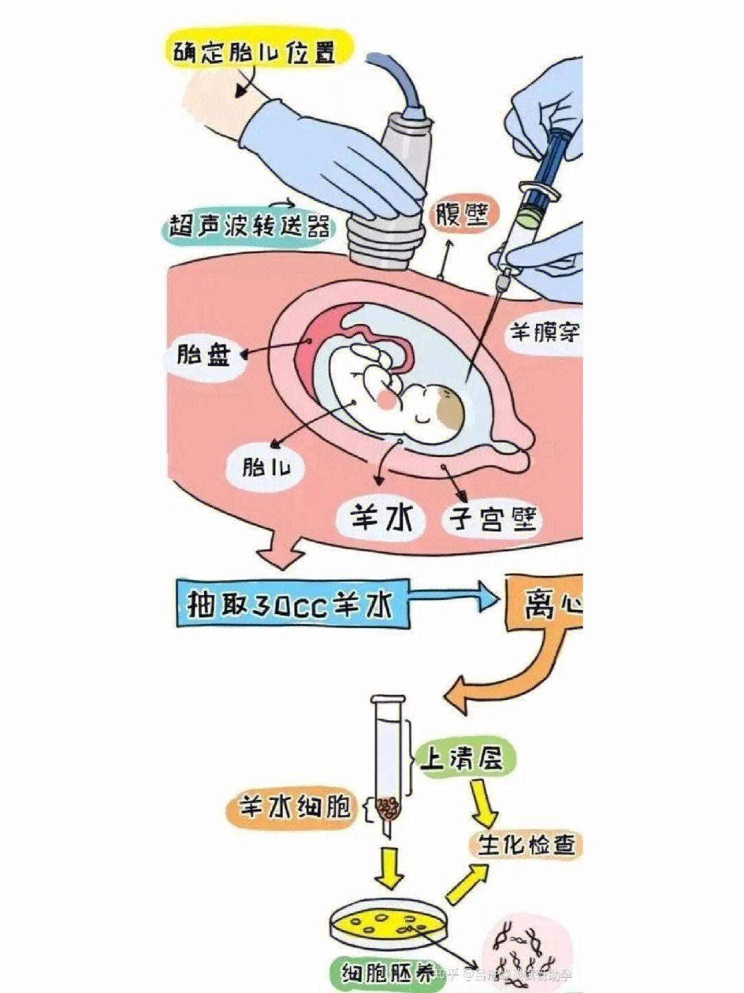 “羊水穿了个洞，自愈是神话吗？”