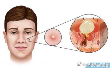 挤了三角区痘痘，小心颅内风暴来袭！