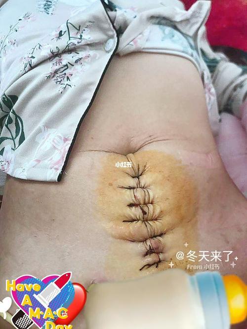 剖腹产的孩子都废了？：荒诞视角下的女性话题