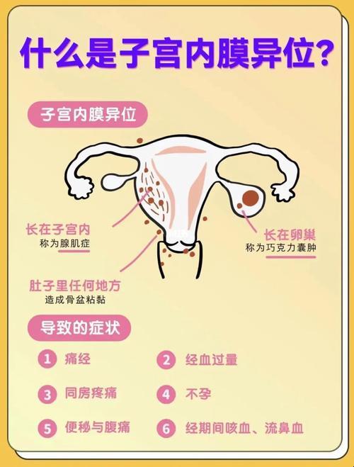 子宫内膜异位，该怎么“侦破”这个磨人的小妖精？