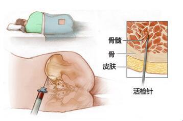 骨穿疑云：探寻生命深处的秘密