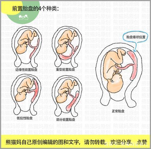 “前置胎盘”偏好群体：揭秘那些“得天独厚”的幸运儿