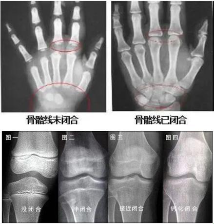 骨骼线闭合？这事儿得“骨骼清奇”才能参透！