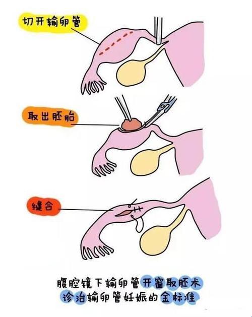 “输卵管上的意外：宫外孕手术，一场生命的转折点”