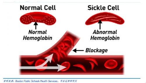 镰刀型细胞贫血症，百度百科的“萌新”解读！