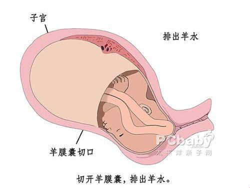 剖腹产怎么排羊水？笑谈现代生育的奇趣现象