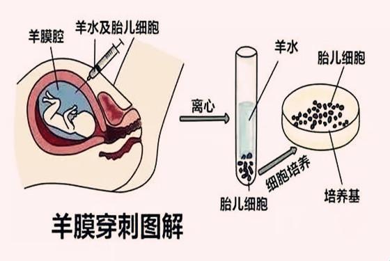 孕妇羊水穿刺，揭秘生命的“神秘面纱”