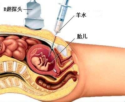 抽羊水，揭秘宝宝秘密的神奇项目大揭秘！