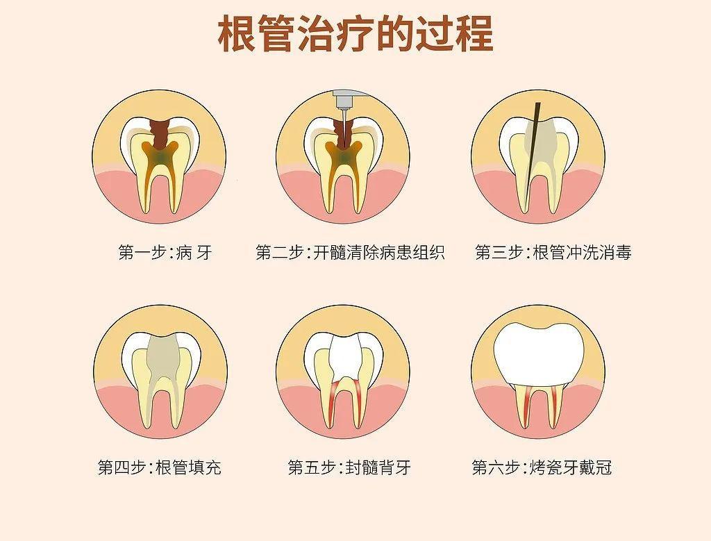 “根管治疗三部曲，痛不欲生哪个最炫？”