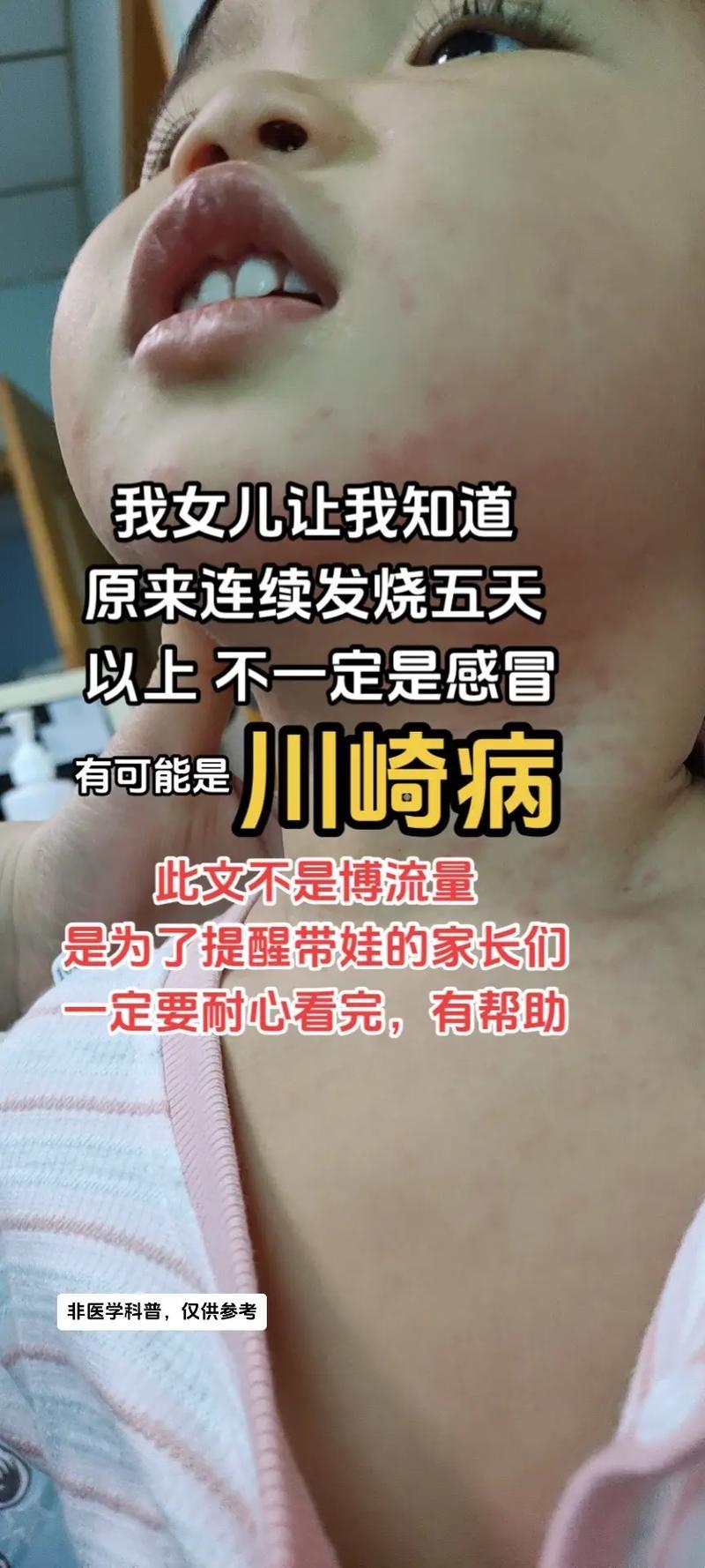 小孩发烧那些事儿：揭秘反复发烧的谜团