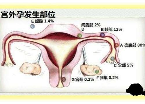 小腹疼得离谱？别慌，疑似宫外孕的“幽默”解读