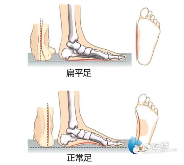 足聊：扁平足与正常足的摄影趣谈