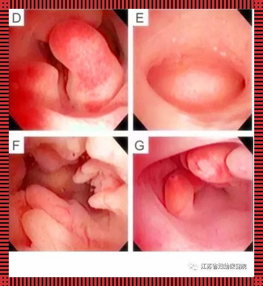 “子宫内膜多了十几个‘小客人’，怎么办？”