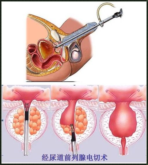 前列腺电切术：利与弊的荒诞探析