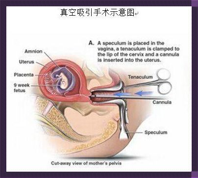 “人流手术要做什么准备”：《笑谈“小风波”前的备战攻略》