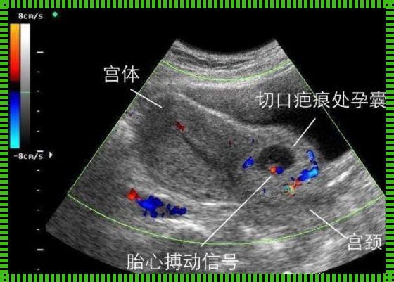 “孕囊附疤，喜剧还是悲剧？”