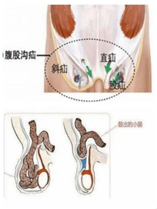 “疝气”不请自去，何须挂号问诊？