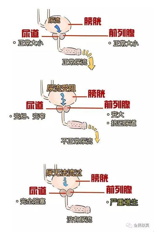 前列腺增生伴钙化，事儿大如天崩地裂？