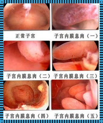 “内膜息肉”这家伙的六个捣蛋前兆，别不当一回事！