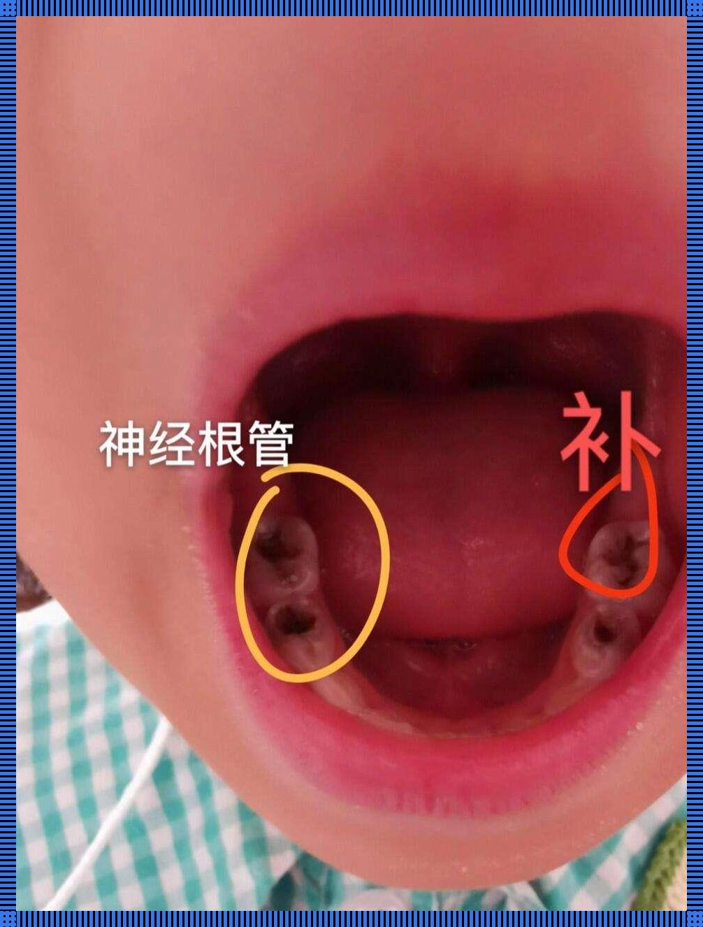 乳牙修复，四岁娃的笑料还是苦恼？