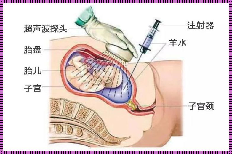 羊水一把，揭秘穿刺那些事儿