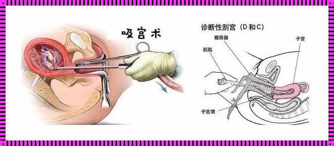 “刮宫”二次方，人流大不同：探讨二者之间的奇妙差异