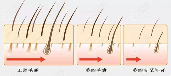 “毛囊失踪疑云”：揭秘毛发背后的神秘面纱