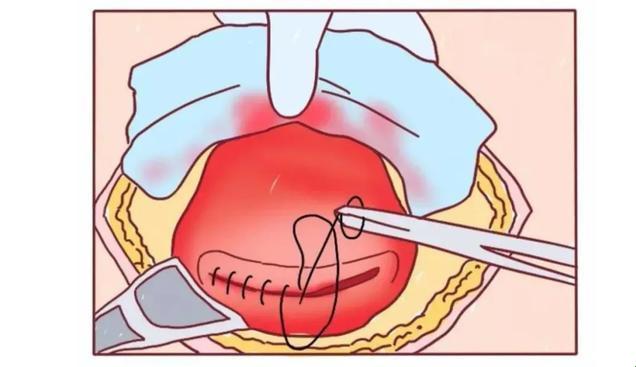 一剪没两次？揭秘剖腹产的同切口之谜